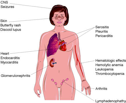 Systemic Lupus Erythematosus.jpg