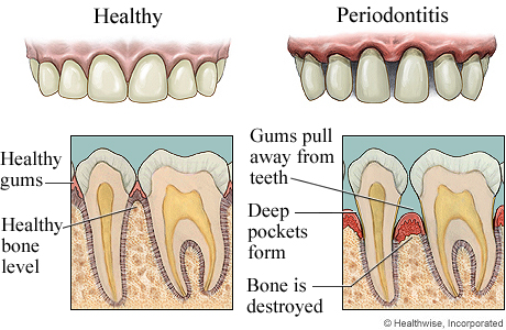 Gum disease.jpg