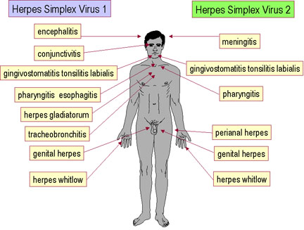 Herpes.jpg
