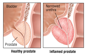 Prostatitis.jpg