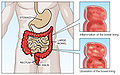 Ulcerative Colitis.jpg