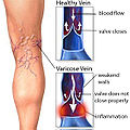 Varicose-veins.jpg