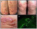 Dermatitis Herpetiformis.jpg