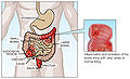 Crohn's disease.jpg