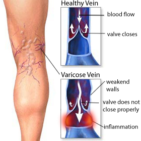 Varicose-veins.jpg